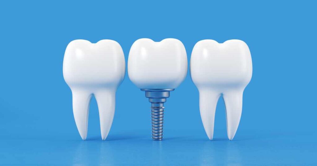 Local Dental Implants Treatment Information