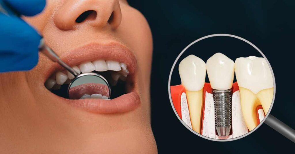 Dental Implant Shopping Online