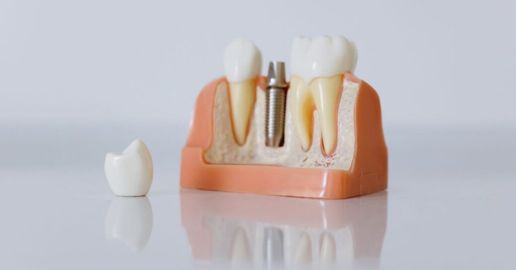 The Future of Online Dental Implant Shopping: Trends to Watch